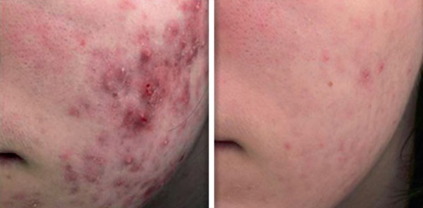 MaQX treatment of active acne
