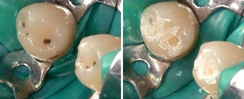Carious Dentine Removal