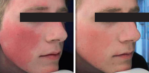 MaQX treatment of facial redness