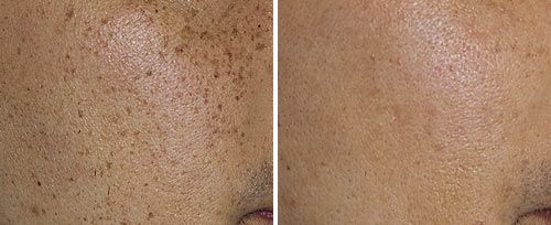 Pigmented Lesions Treatment